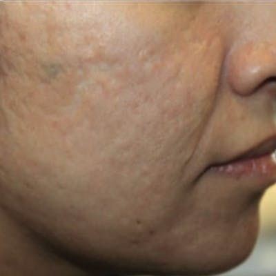 Acne Before & After Gallery - Patient 173546977 - Image 2