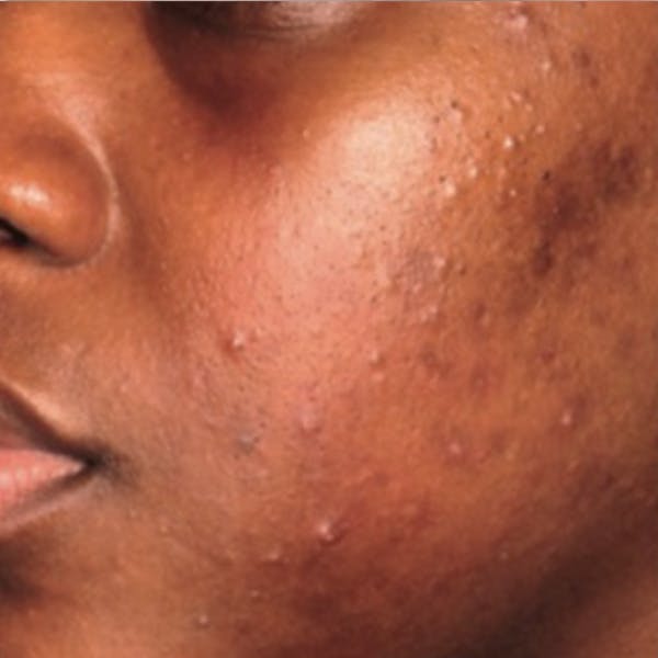 Acne Before & After Gallery - Patient 173546978 - Image 1