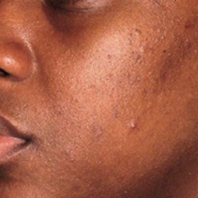 Acne Before & After Gallery - Patient 173546978 - Image 2