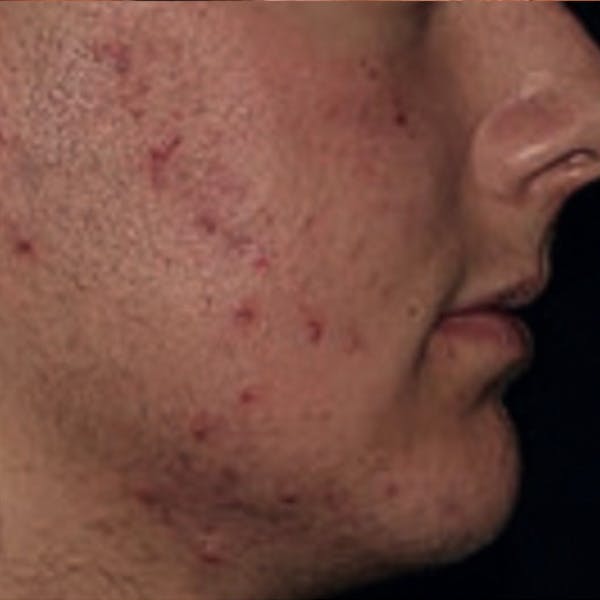 Acne Before & After Gallery - Patient 173546979 - Image 1