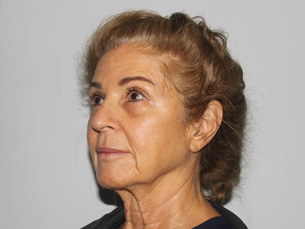 Facelift Before & After Gallery - Patient 149236324 - Image 3
