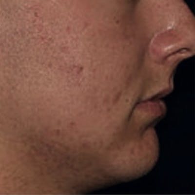 Acne Before & After Gallery - Patient 173546979 - Image 2