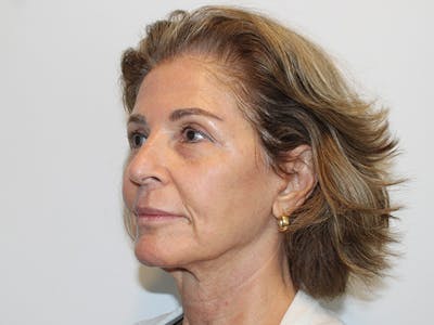 Facelift Before & After Gallery - Patient 149236324 - Image 4
