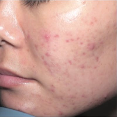 Acne Before & After Gallery - Patient 173546980 - Image 1
