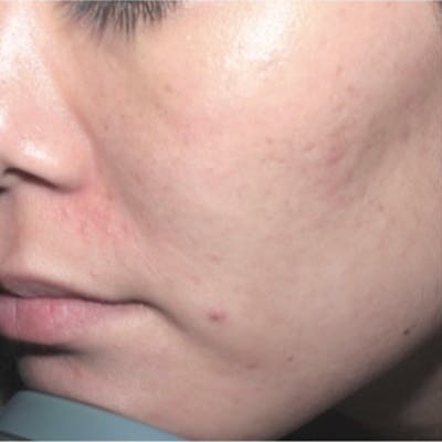 Acne Before & After Gallery - Patient 173546980 - Image 2