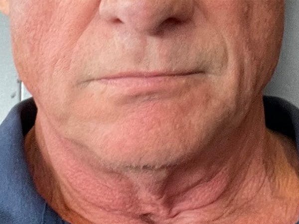 Facelift Before & After Gallery - Patient 173546925 - Image 1