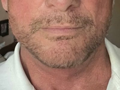 Facial Rejuvenation Before & After Gallery - Patient 447874 - Image 2