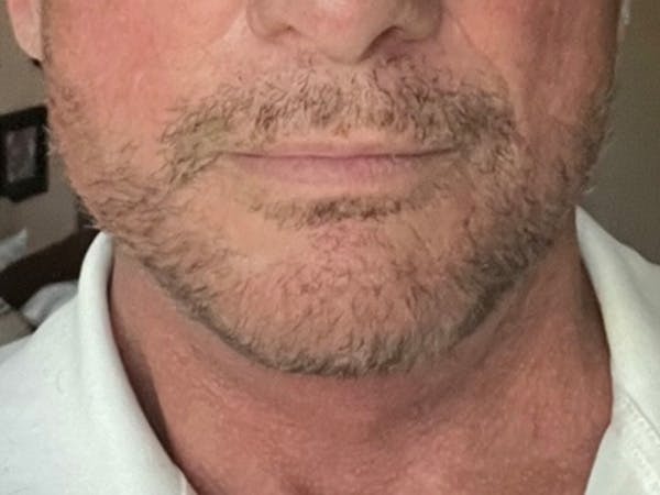 Facial Rejuvenation Before & After Gallery - Patient 447874 - Image 2