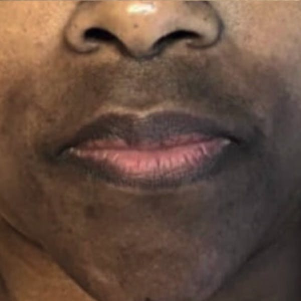 Hyperpigmentation Before & After Gallery - Patient 173547000 - Image 1