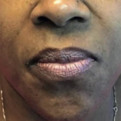 Hyperpigmentation Before & After Gallery - Patient 173547000 - Image 2