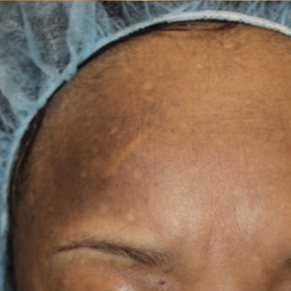 Melasma Before & After Gallery - Patient 173547008 - Image 1