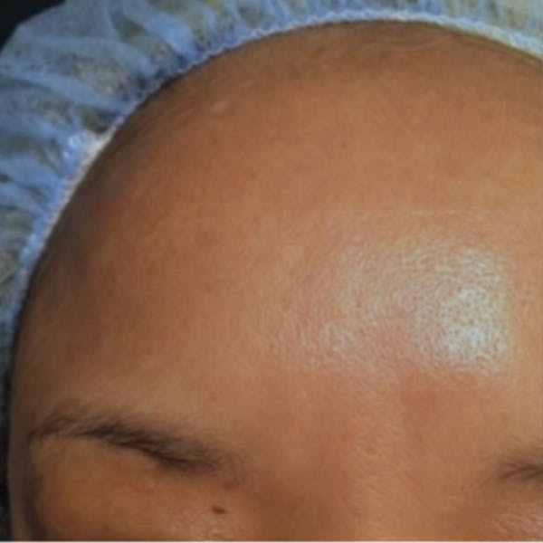 Melasma Before & After Gallery - Patient 173547008 - Image 2