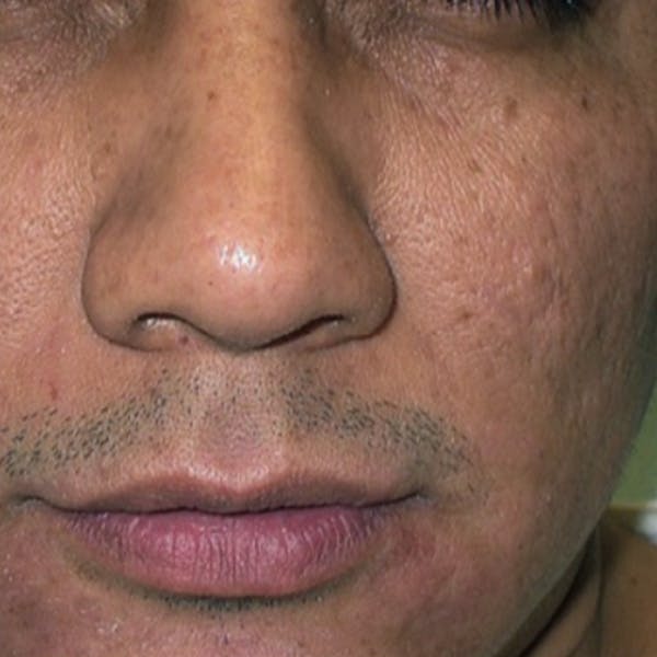 Rejuvenation and Tightening Before & After Gallery - Patient 173547025 - Image 2