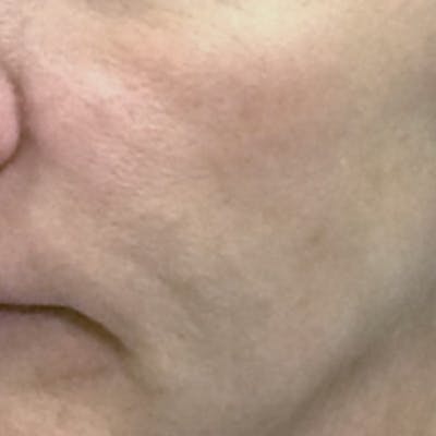 Rejuvenation and Tightening Before & After Gallery - Patient 173547026 - Image 1