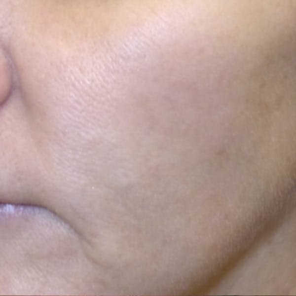 Rejuvenation and Tightening Before & After Gallery - Patient 173547026 - Image 2