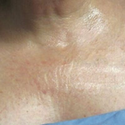 Rejuvenation and Tightening Before & After Gallery - Patient 173547027 - Image 1