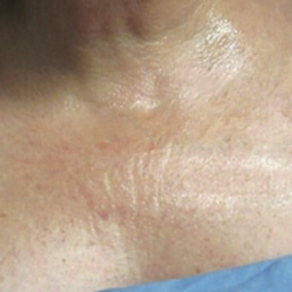 Rejuvenation and Tightening Before & After Gallery - Patient 173547027 - Image 1