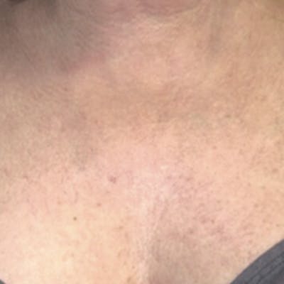 Rejuvenation and Tightening Before & After Gallery - Patient 173547027 - Image 2