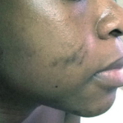 Scar Treatment Before & After Gallery - Patient 173547035 - Image 1