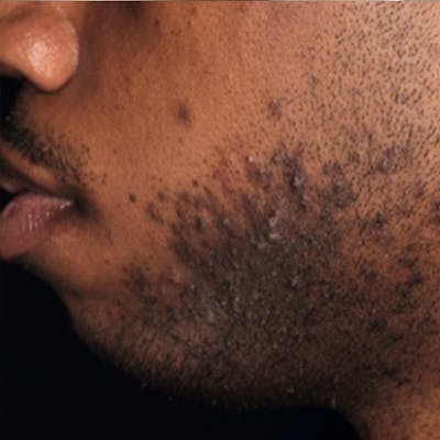Scar Treatment Before & After Gallery - Patient 173547036 - Image 1