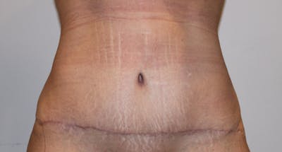 Tummy Tuck Before & After Gallery - Patient 176987410 - Image 2