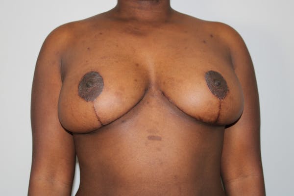 Breast Lift Before & After Gallery - Patient 176987432 - Image 2