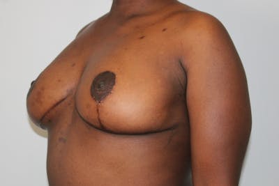Breast Lift Before & After Gallery - Patient 176987432 - Image 6