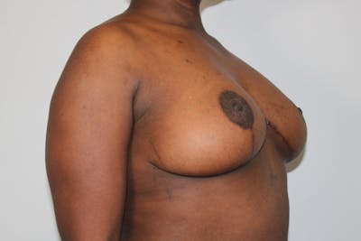 Breast Lift Before & After Gallery - Patient 176987432 - Image 4