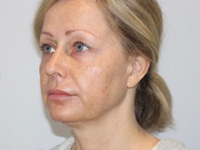 Facelift Before & After Gallery - Patient 183177755 - Image 1
