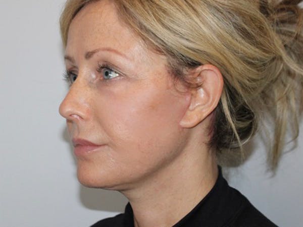 Facelift Before & After Gallery - Patient 183177755 - Image 2