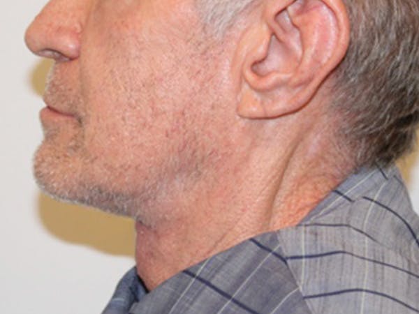 Facial Rejuvenation Before & After Gallery - Patient 188667058 - Image 2