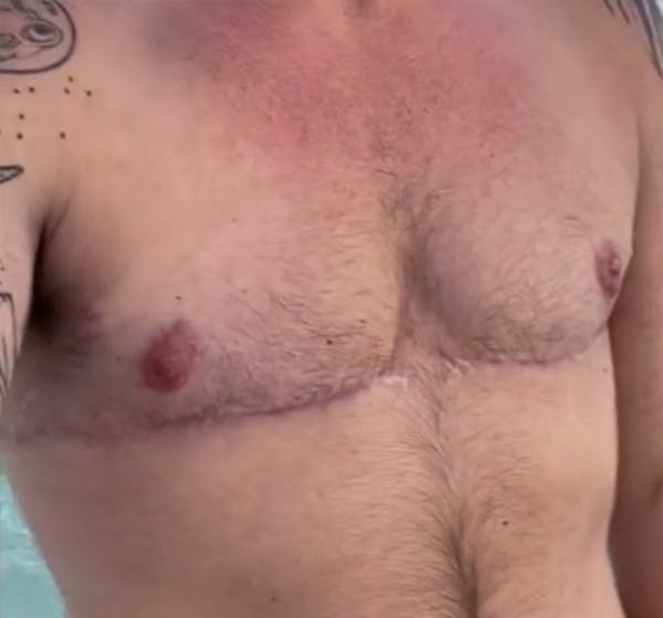 Female to Male Before & After Gallery - Patient 258224 - Image 2