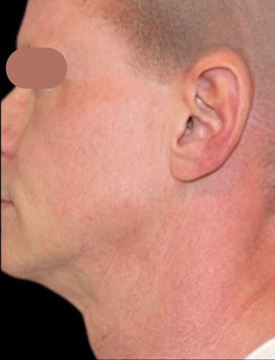 Facial Rejuvenation Before & After Gallery - Patient 382996 - Image 2