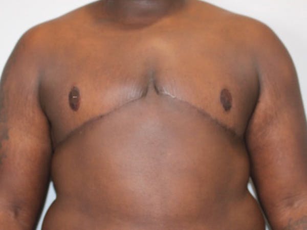 Female to Male Before & After Gallery - Patient 131954 - Image 2