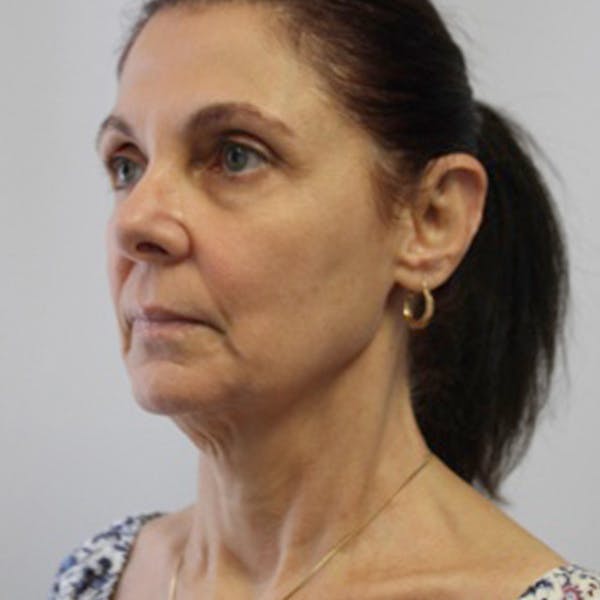 Facelift Before & After Gallery - Patient 289451 - Image 1
