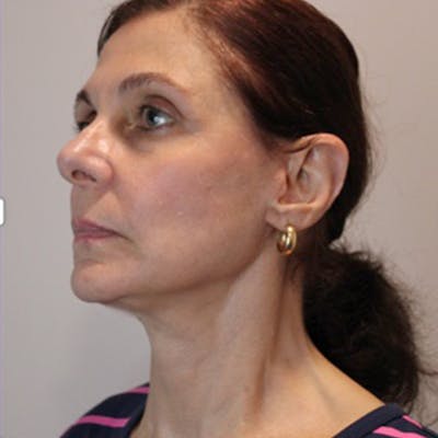 Facelift Before & After Gallery - Patient 289451 - Image 2