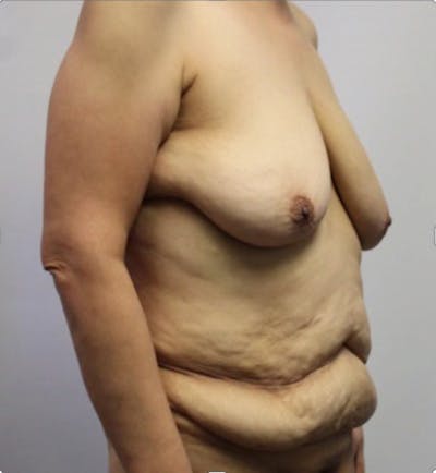 Tummy Tuck Before & After Gallery - Patient 366771 - Image 1