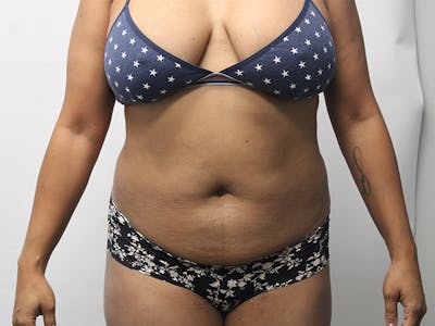 Liposuction Before & After Gallery - Patient 305266 - Image 1