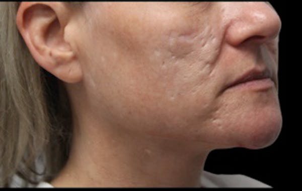 Skin Resurfacing Before & After Gallery - Patient 213265 - Image 1