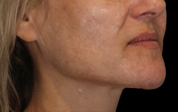 Skin Resurfacing Before & After Gallery - Patient 213265 - Image 2