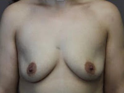 Breast Augmentation Before & After Gallery - Patient 393734 - Image 1