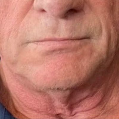 Neck Lift Before & After Gallery - Patient 168206 - Image 1