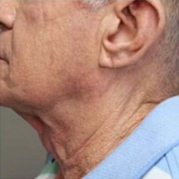 Neck Lift Before & After Gallery - Patient 168206 - Image 3
