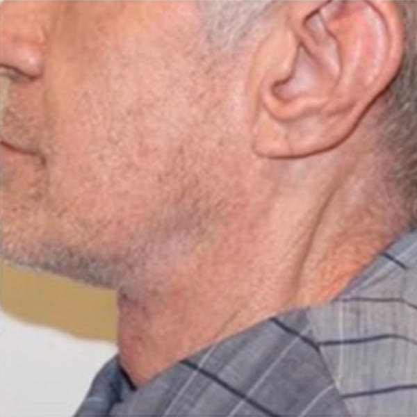 Neck Lift Before & After Gallery - Patient 168206 - Image 4