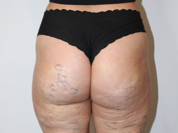 Cellulite Treatment With Aveli Before & After Gallery - Patient 953107 - Image 1