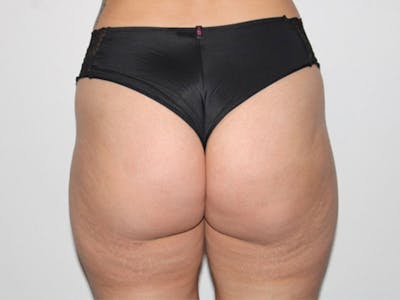 Cellulite Treatment With Aveli Before & After Gallery - Patient 953107 - Image 2