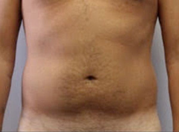 Liposuction For Men Before & After Gallery - Patient 312555 - Image 1