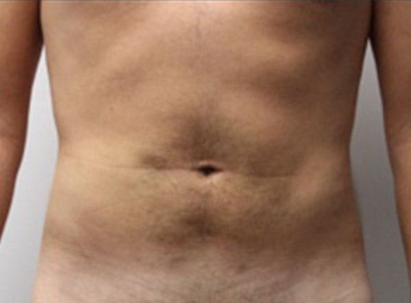 Liposuction Before & After Gallery - Patient 701928 - Image 2