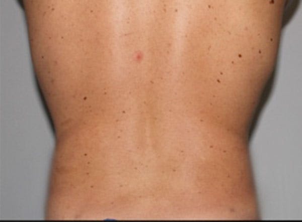 Liposuction For Men Before & After Gallery - Patient 312555 - Image 4