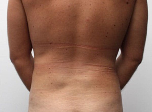 Liposuction For Men Before & After Gallery - Patient 312555 - Image 3